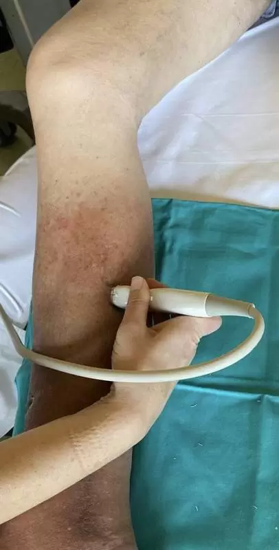 kolor dopler krvnih sudova nogu