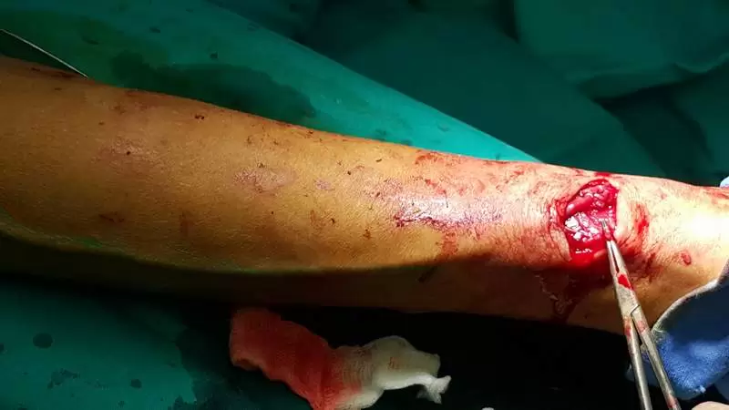 Ugradnja fistule za dijalizu
