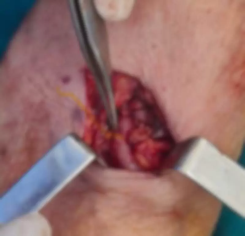 fistula za hemodijalizu