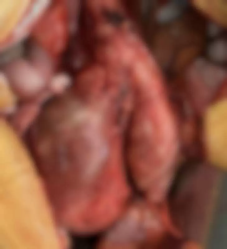 tromb u aneurizmi ilijačne arterije