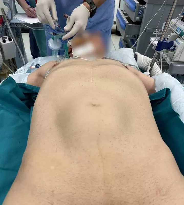 abdominalna aneurizma pred početak operacije