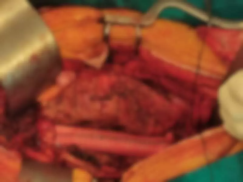 rekonstruisana aneurizma abdominalne aorte