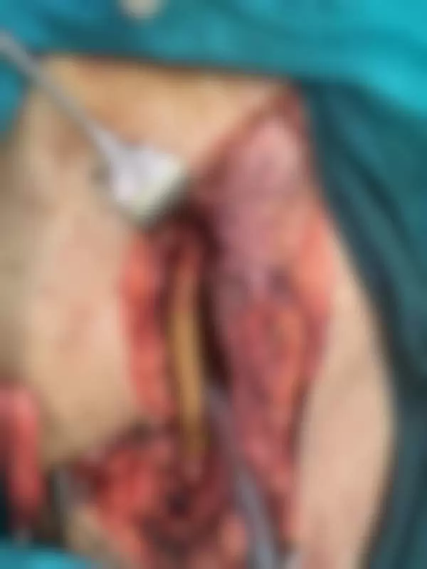 bajpas operacija na nogama