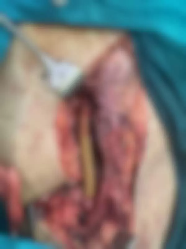 bajpas operacija na nogama 1