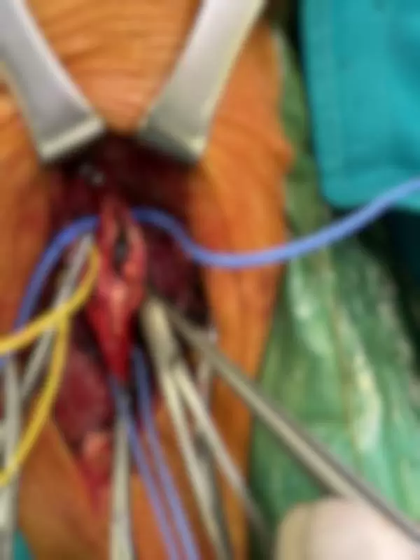 karotida arterija